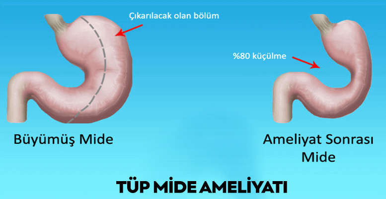 Tüp Mide Ameliyatı